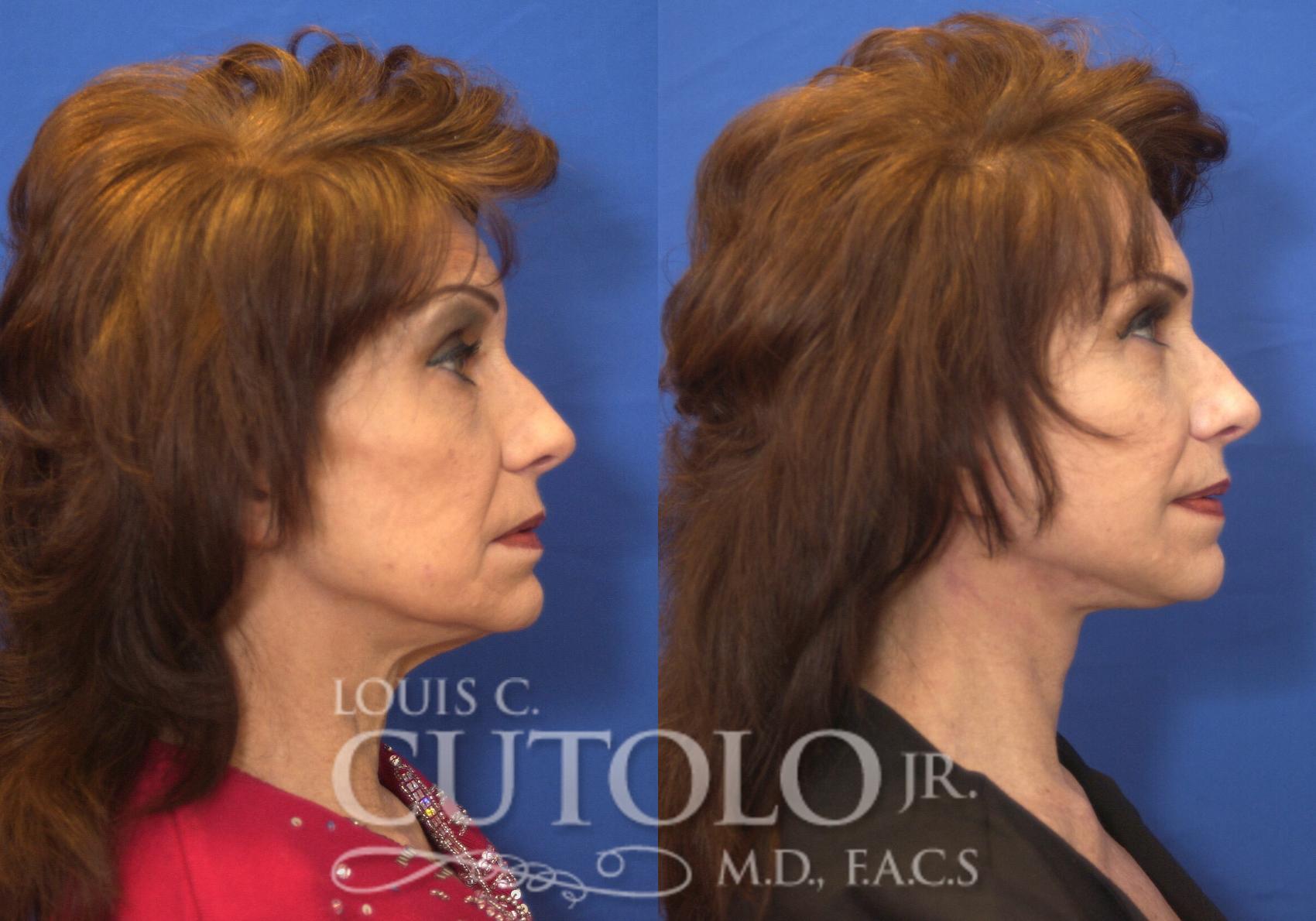 Before & After Rejuvelift™ - Mini Lift Case 218 View #5 View in Brooklyn, Staten Island, Queens, NY