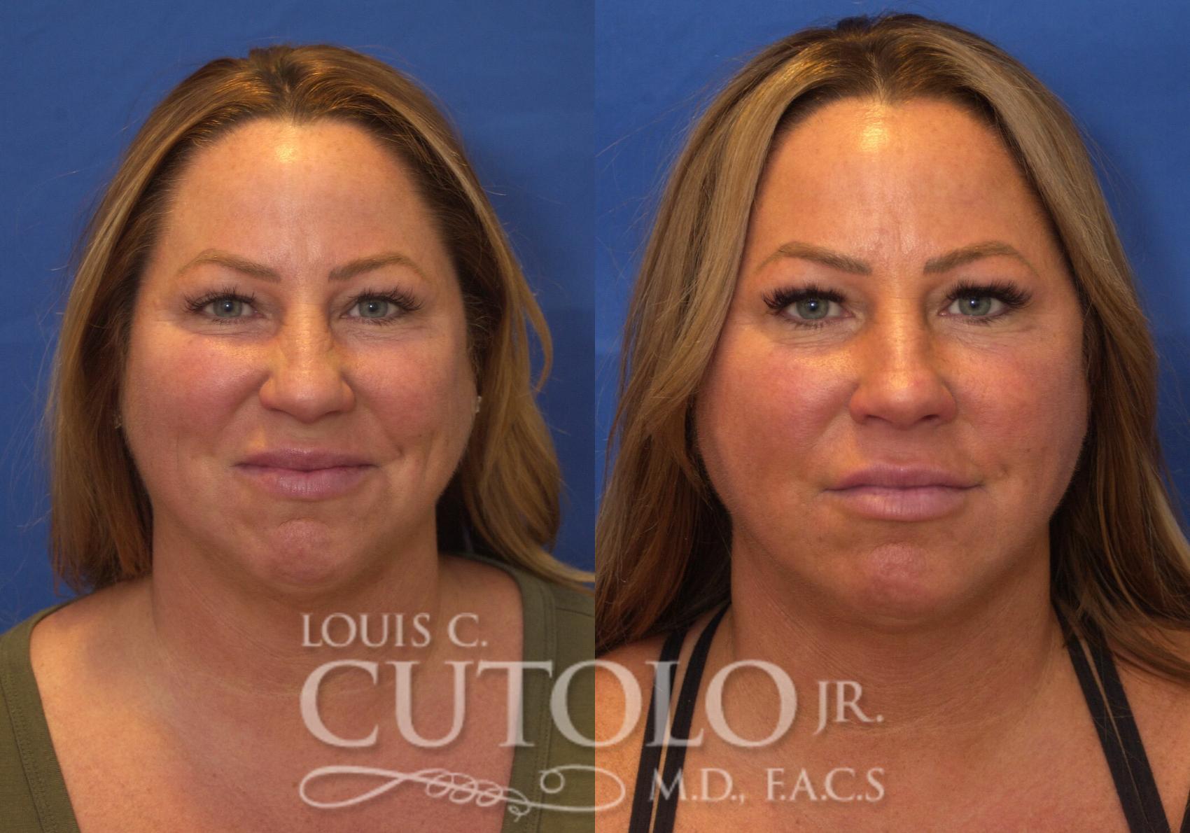Before & After Rejuvelift™ Case 223 View #1 View in Brooklyn, Staten Island, Queens, NY