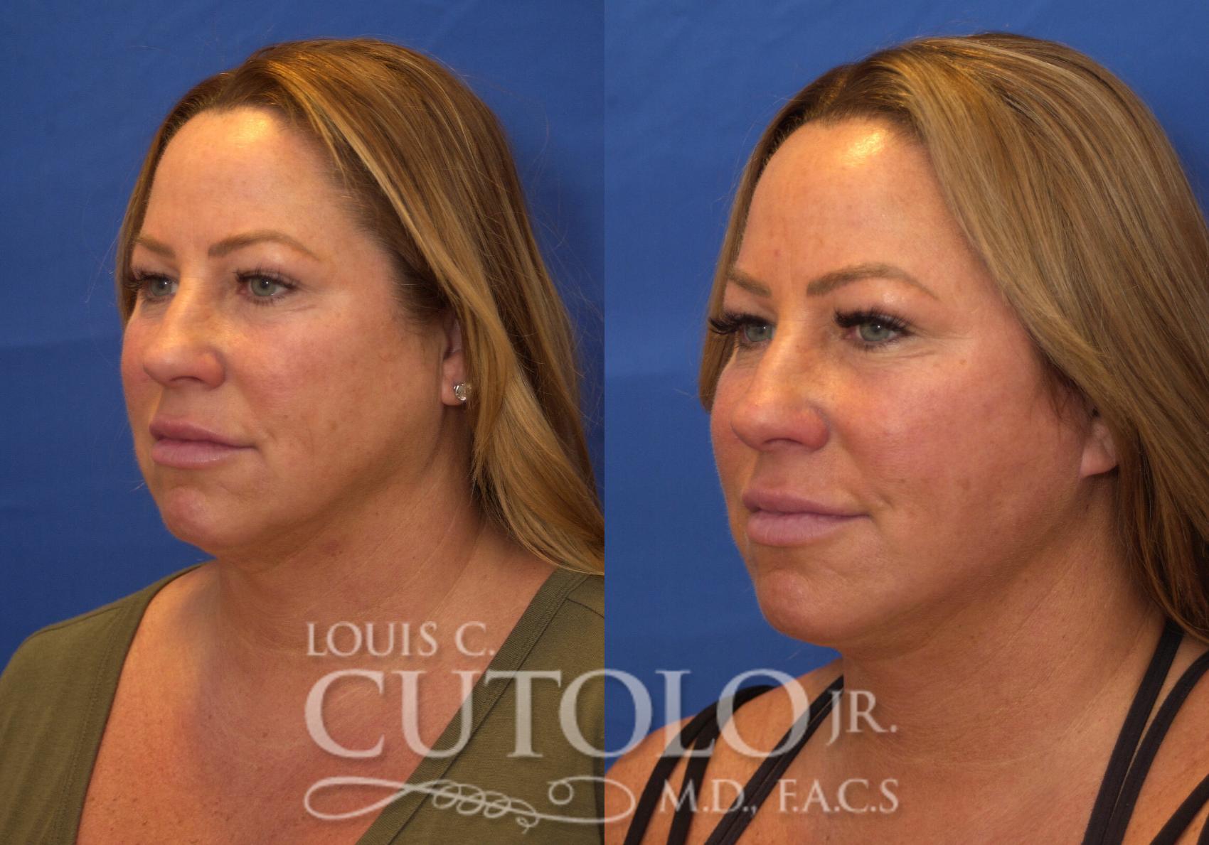 Before & After Rejuvelift™ - Mini Lift Case 223 View #2 View in Brooklyn, Staten Island, Queens, NY