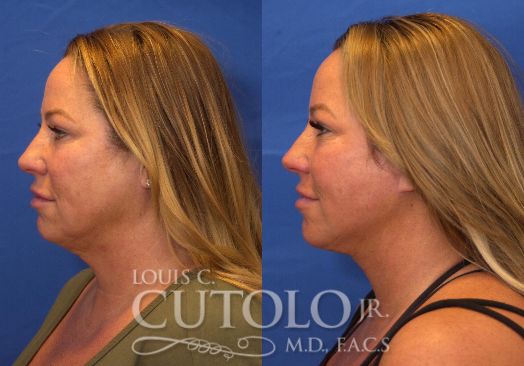 Before & After Rejuvelift™ - Mini Lift Case 223 View #3 View in Brooklyn, Staten Island, Queens, NY