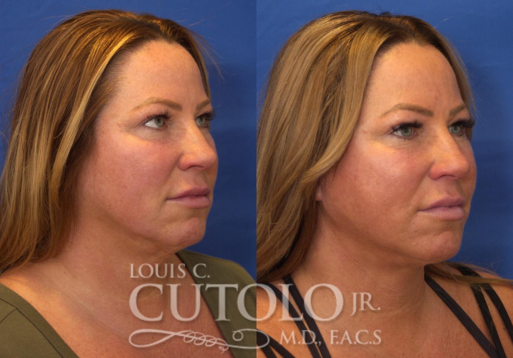 Before & After Rejuvelift™ - Mini Lift Case 223 View #4 View in Brooklyn, Staten Island, Queens, NY