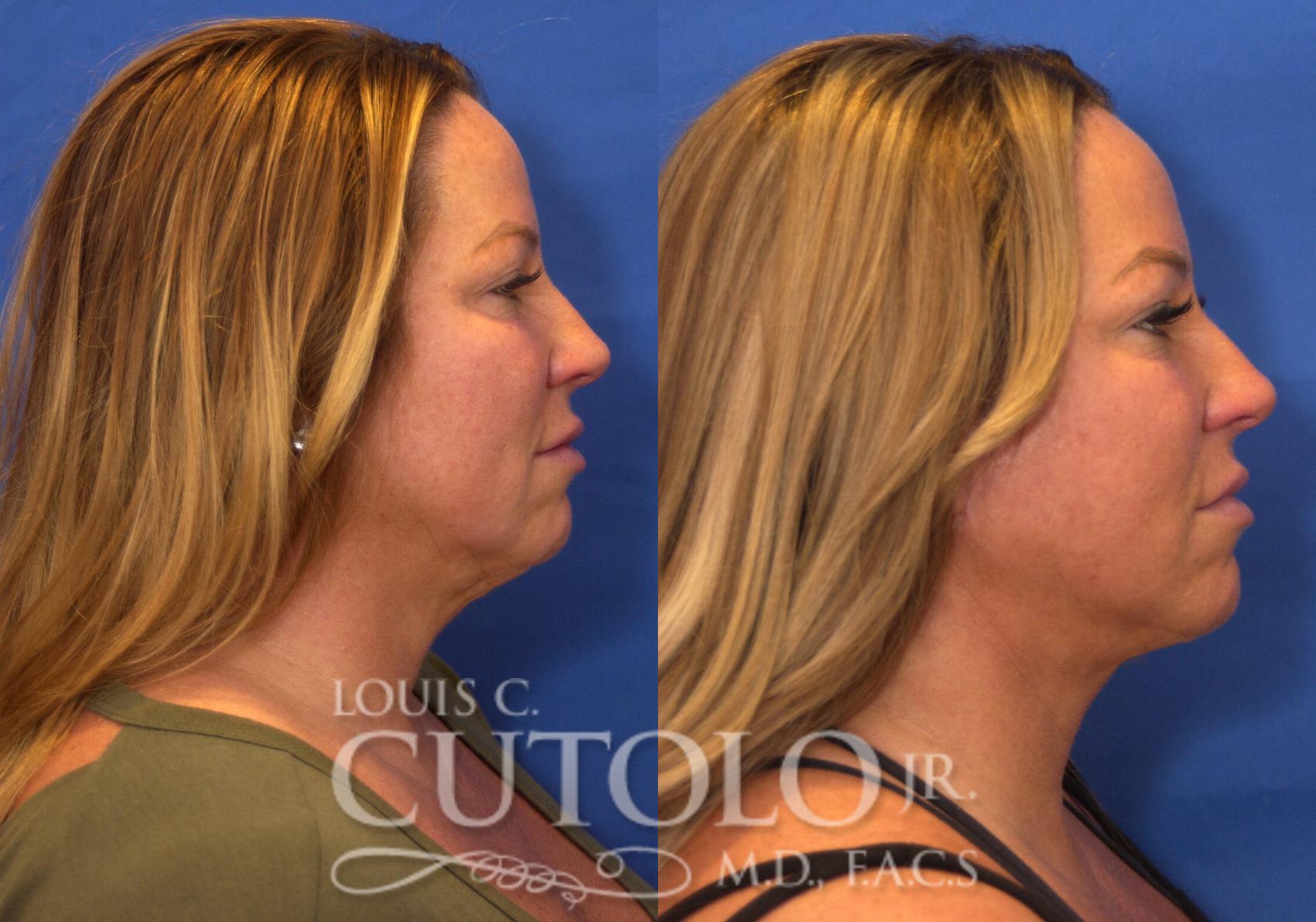Before & After Rejuvelift™ - Mini Lift Case 223 View #5 View in Brooklyn, Staten Island, Queens, NY