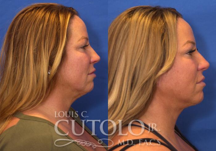Before & After Rejuvelift™ Case 223 View #5 View in Brooklyn, Staten Island, Queens, NY