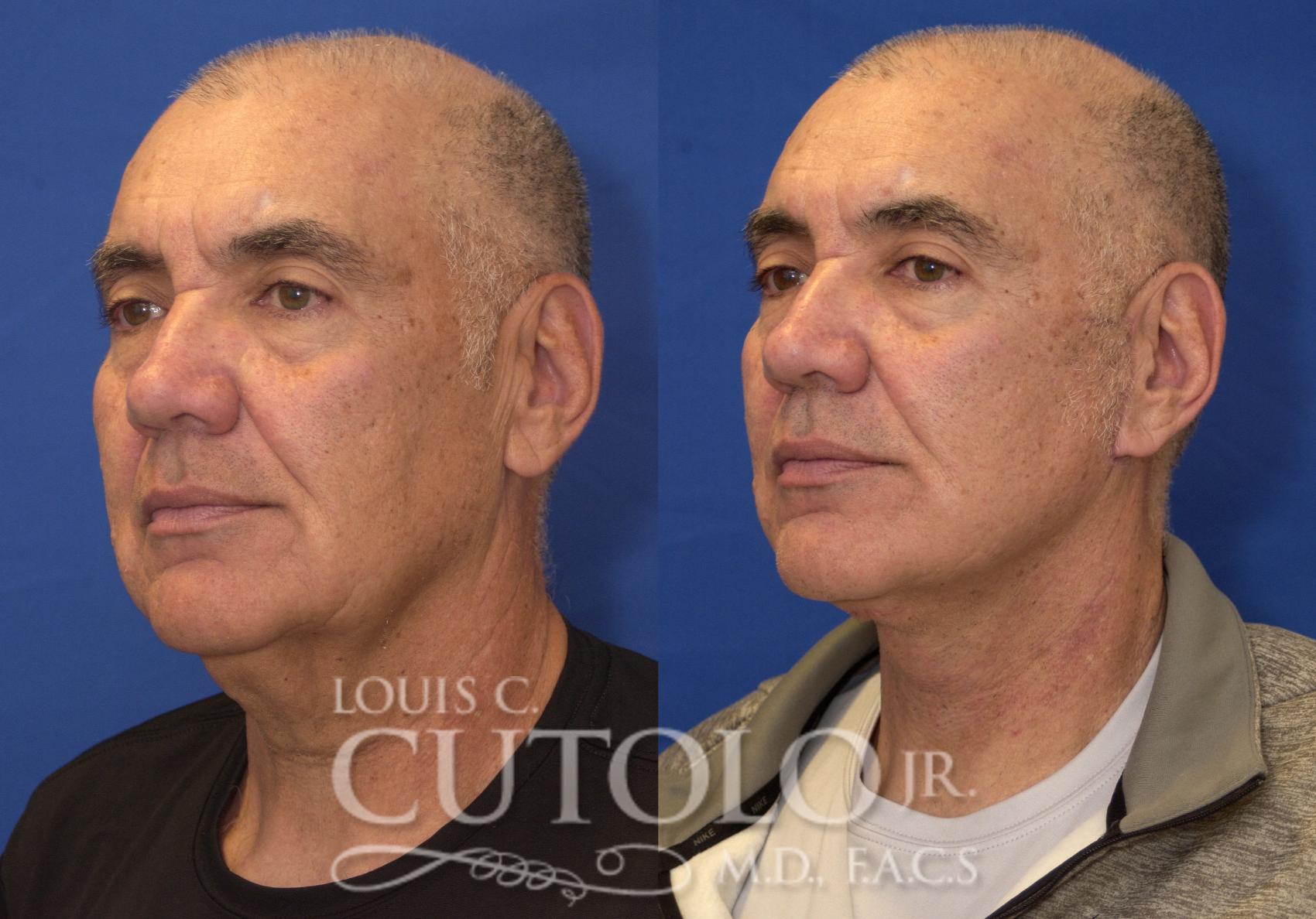 Before & After Rejuvelift™ Case 229 View #2 View in Brooklyn, Staten Island, Queens, NY