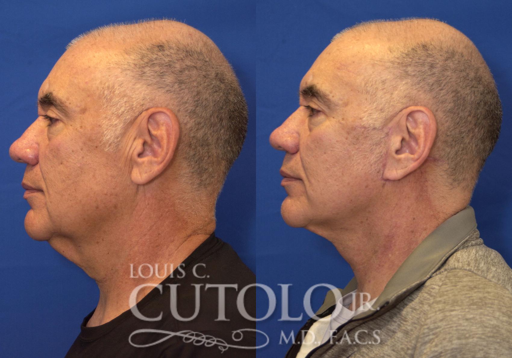 Before & After Rejuvelift™ - Mini Lift Case 229 View #3 View in Brooklyn, Staten Island, Queens, NY