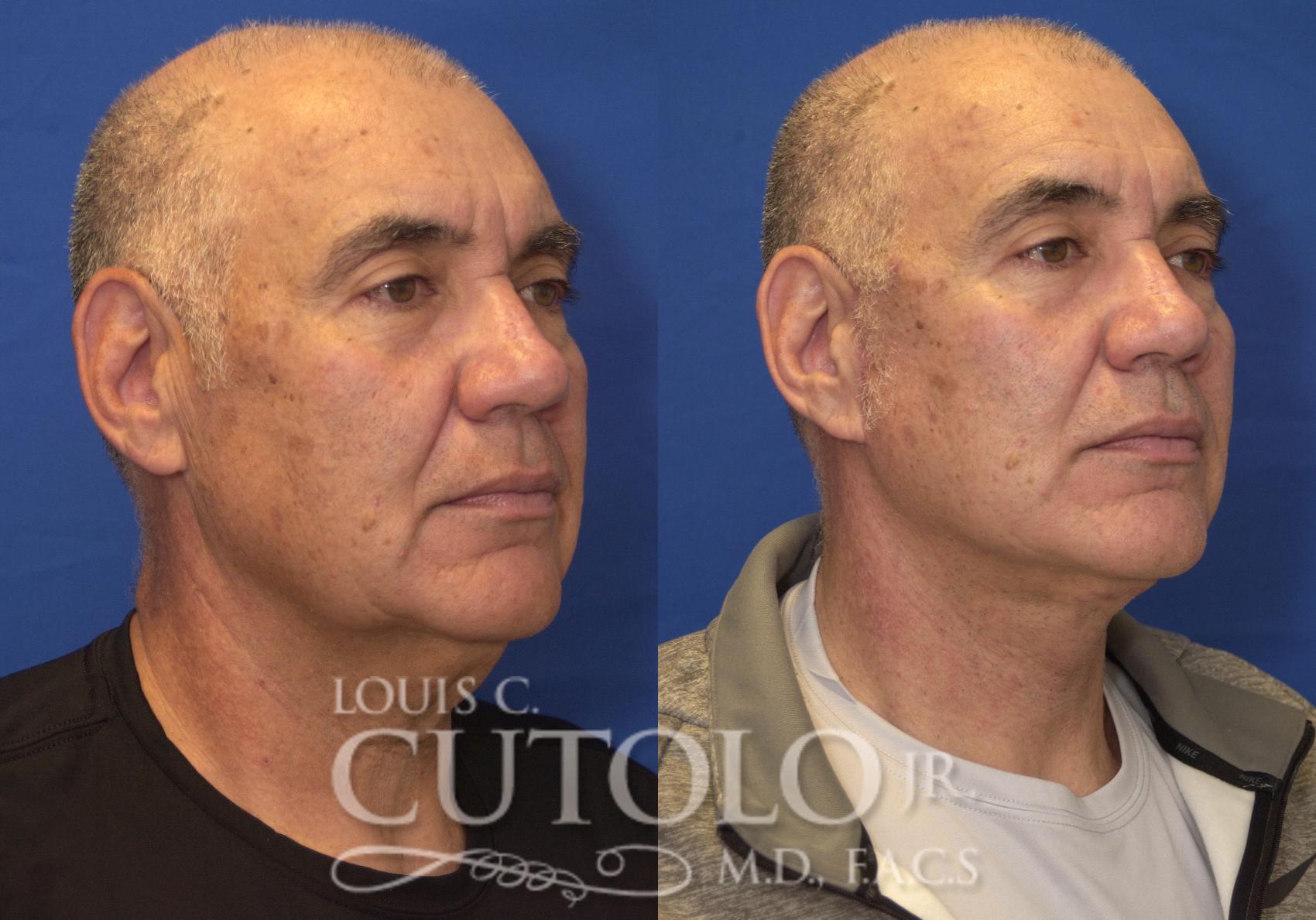 Before & After Rejuvelift™ - Mini Lift Case 229 View #4 View in Brooklyn, Staten Island, Queens, NY