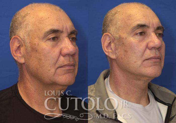 Before & After Rejuvelift™ Case 229 View #4 View in Brooklyn, Staten Island, Queens, NY