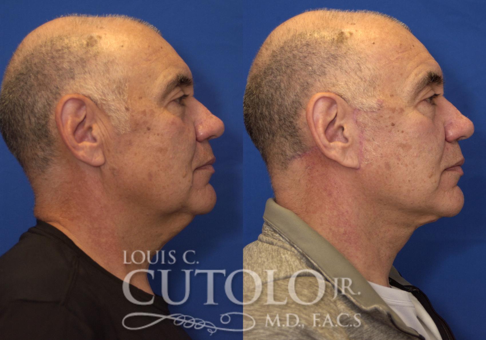 Before & After Rejuvelift™ - Mini Lift Case 229 View #5 View in Brooklyn, Staten Island, Queens, NY