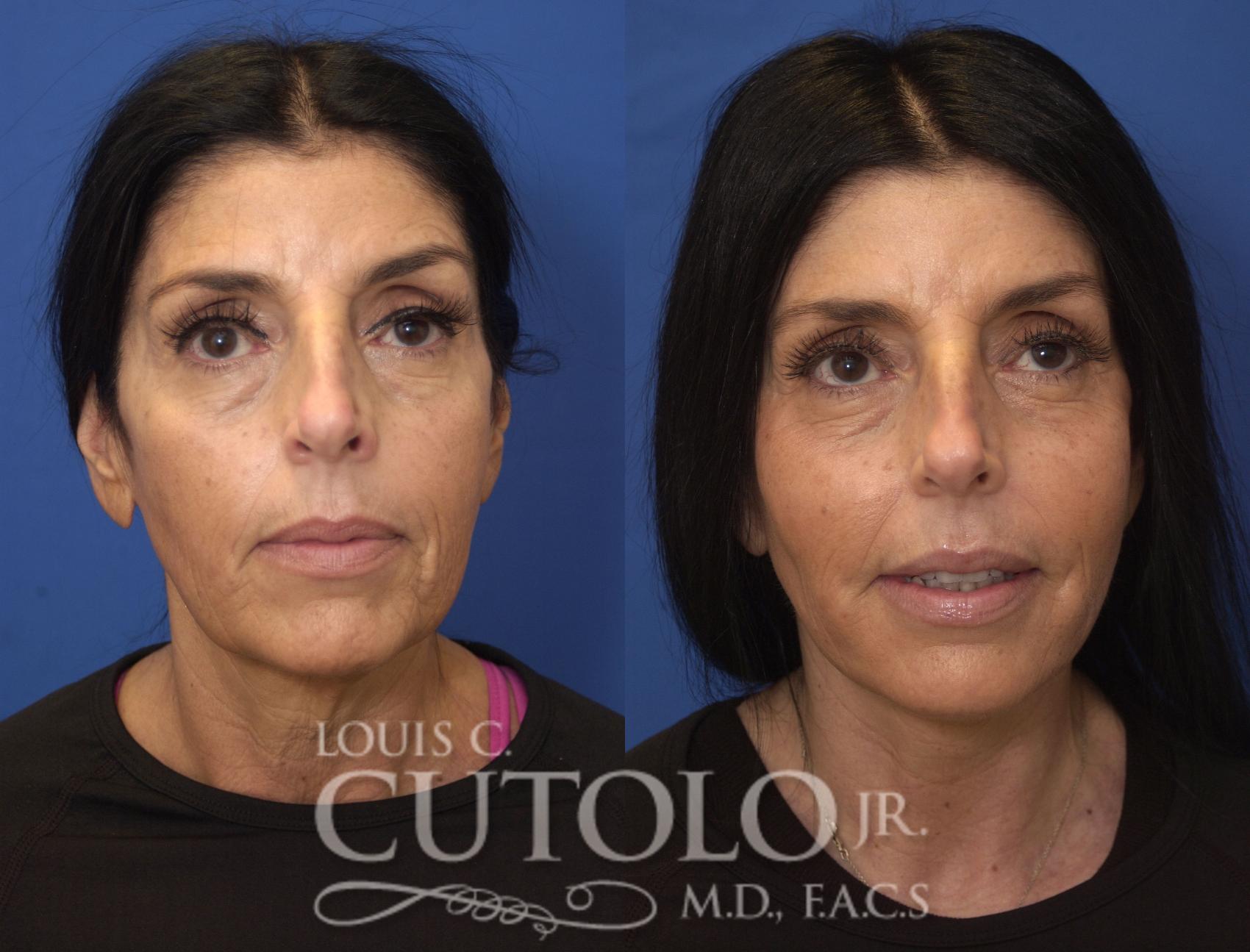 Before & After Rejuvelift™ Case 244 Front View in Brooklyn, Staten Island, Queens, NY