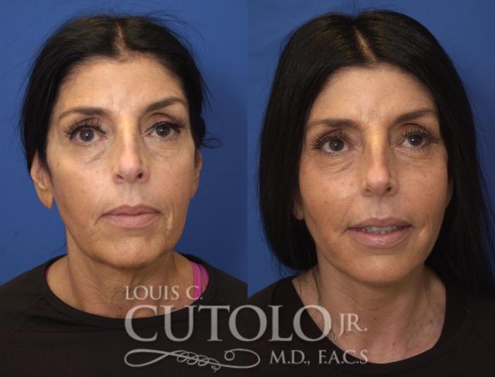 Before & After Rejuvelift™ Case 244 Front View in Brooklyn, Staten Island, Queens, NY