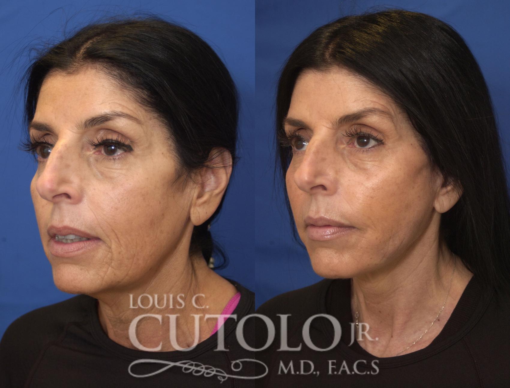 Before & After Rejuvelift™ - Mini Lift Case 244 Left Oblique View in Brooklyn, Staten Island, Queens, NY