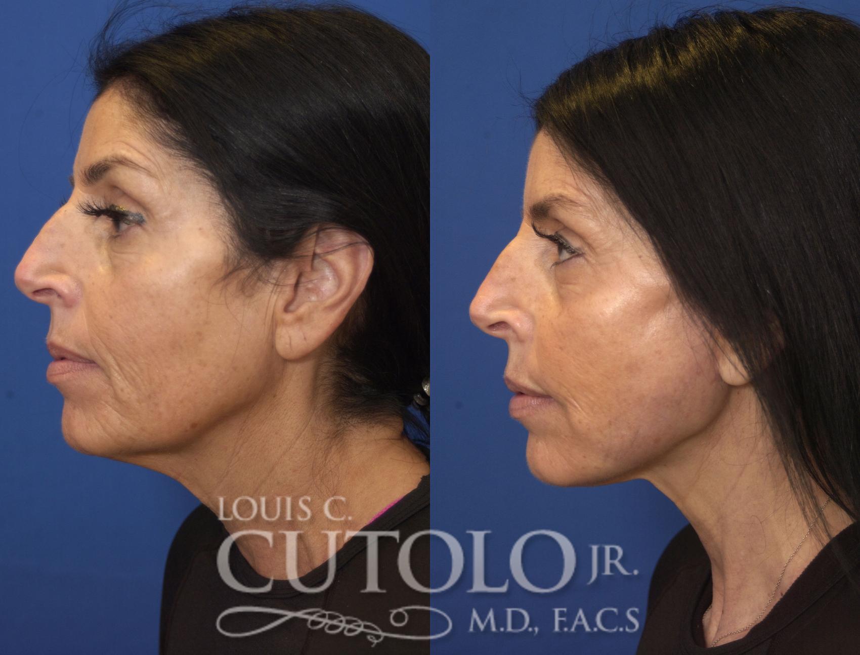 Before & After Rejuvelift™ - Mini Lift Case 244 Left Side View in Brooklyn, Staten Island, Queens, NY