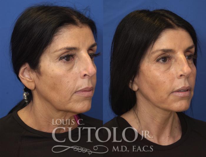 Before & After Rejuvelift™ Case 244 Right Oblique View in Brooklyn, Staten Island, Queens, NY