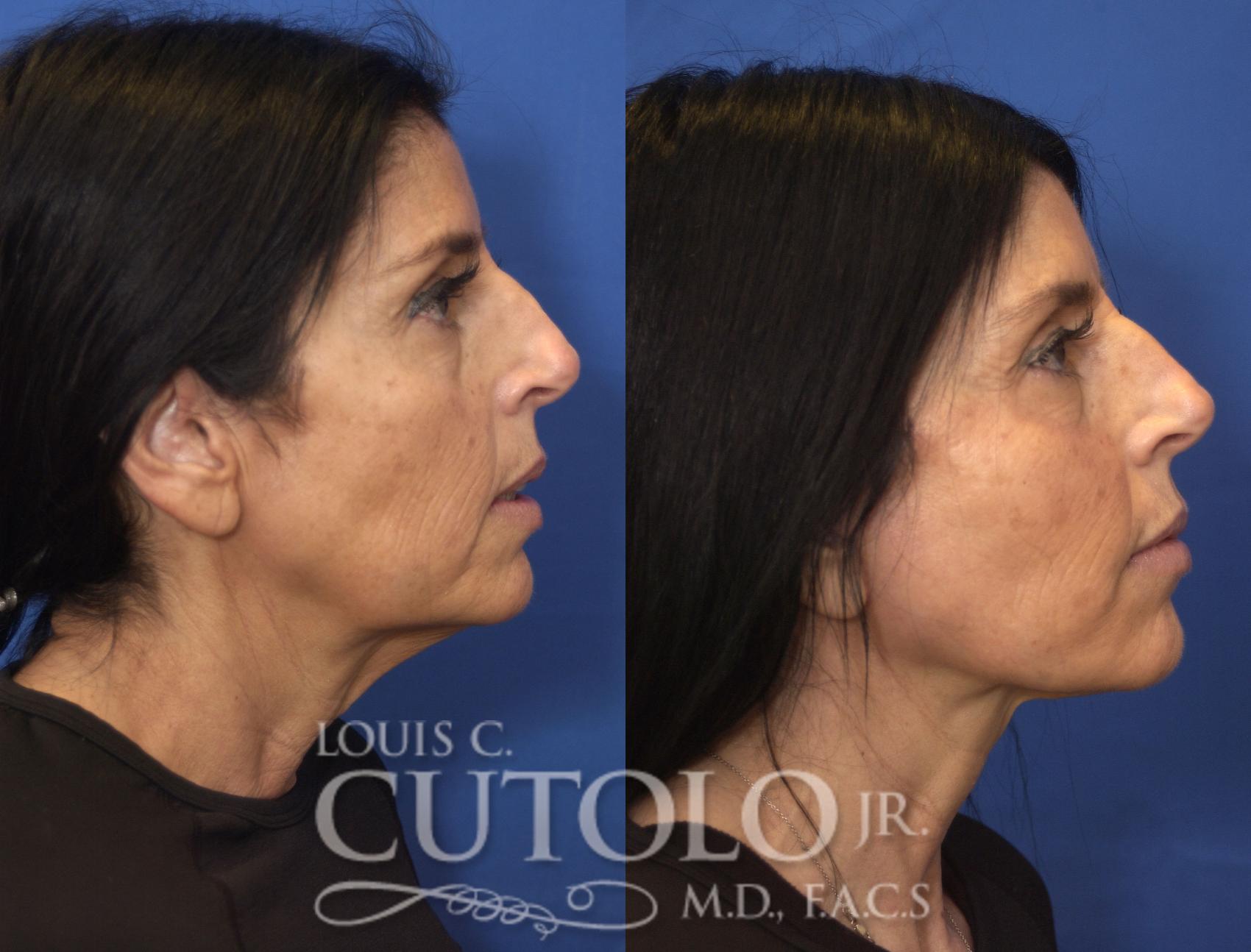 Before & After Rejuvelift™ - Mini Lift Case 244 Right Side View in Brooklyn, Staten Island, Queens, NY