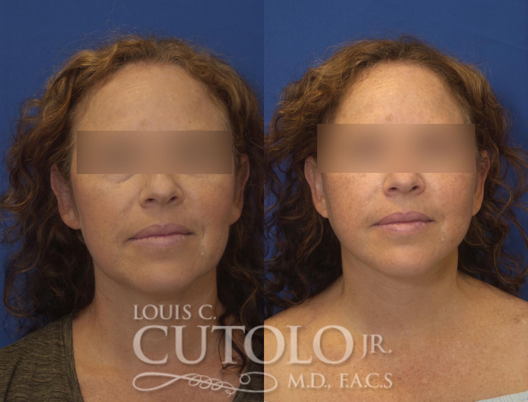 Before & After Rejuvelift™ Case 245 Front View in Brooklyn, Staten Island, Queens, NY