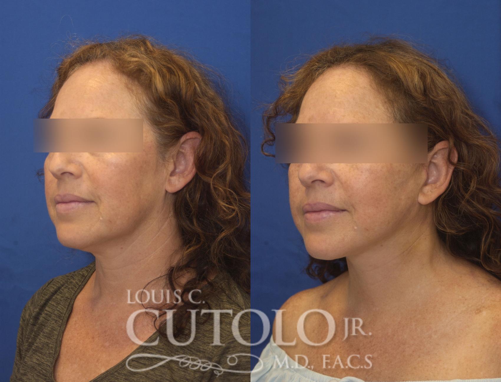 Before & After Rejuvelift™ - Mini Lift Case 245 Left Oblique View in Brooklyn, Staten Island, Queens, NY