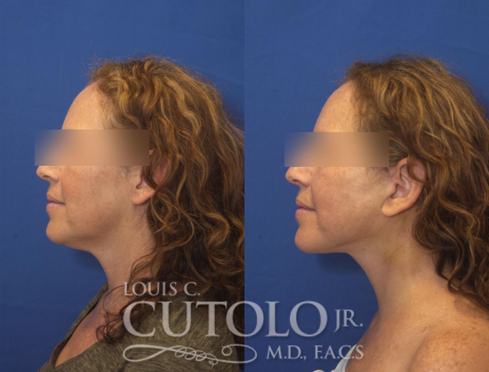 Before & After Rejuvelift™ - Mini Lift Case 245 Left Side View in Brooklyn, Staten Island, Queens, NY