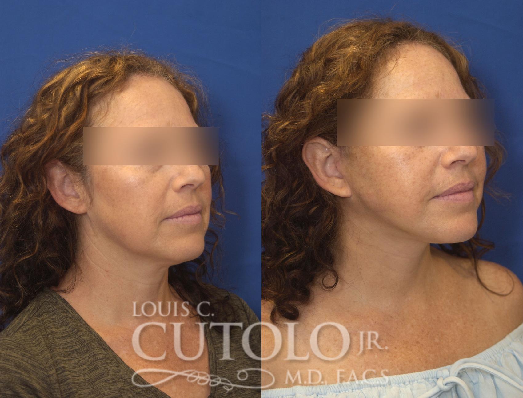 Before & After Rejuvelift™ - Mini Lift Case 245 Right Oblique View in Brooklyn, Staten Island, Queens, NY