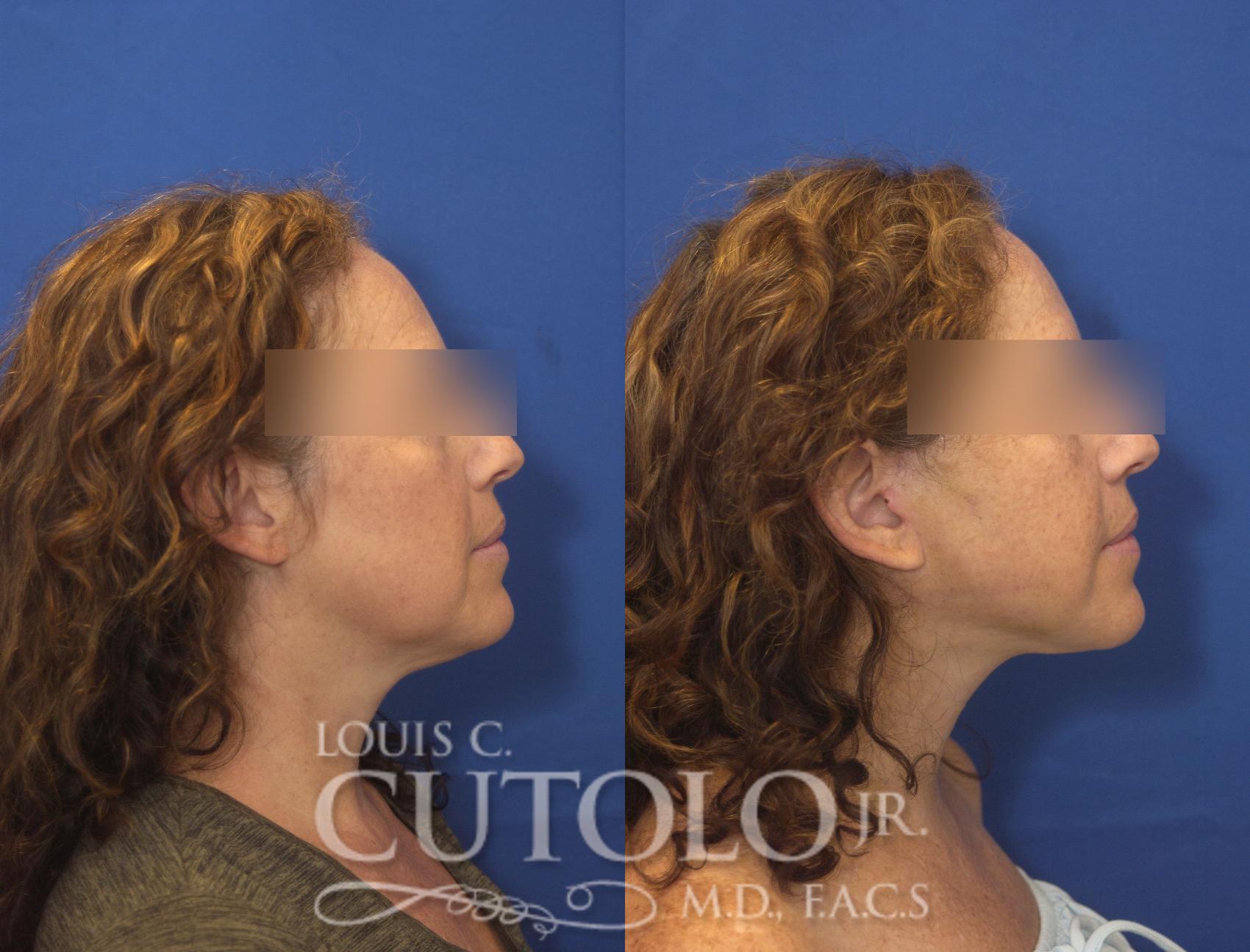 Before & After Rejuvelift™ - Mini Lift Case 245 Right Side View in Brooklyn, Staten Island, Queens, NY