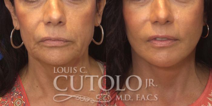 Before & After Rejuvelift™ Case 247 Front View in Brooklyn, Staten Island, Queens, NY