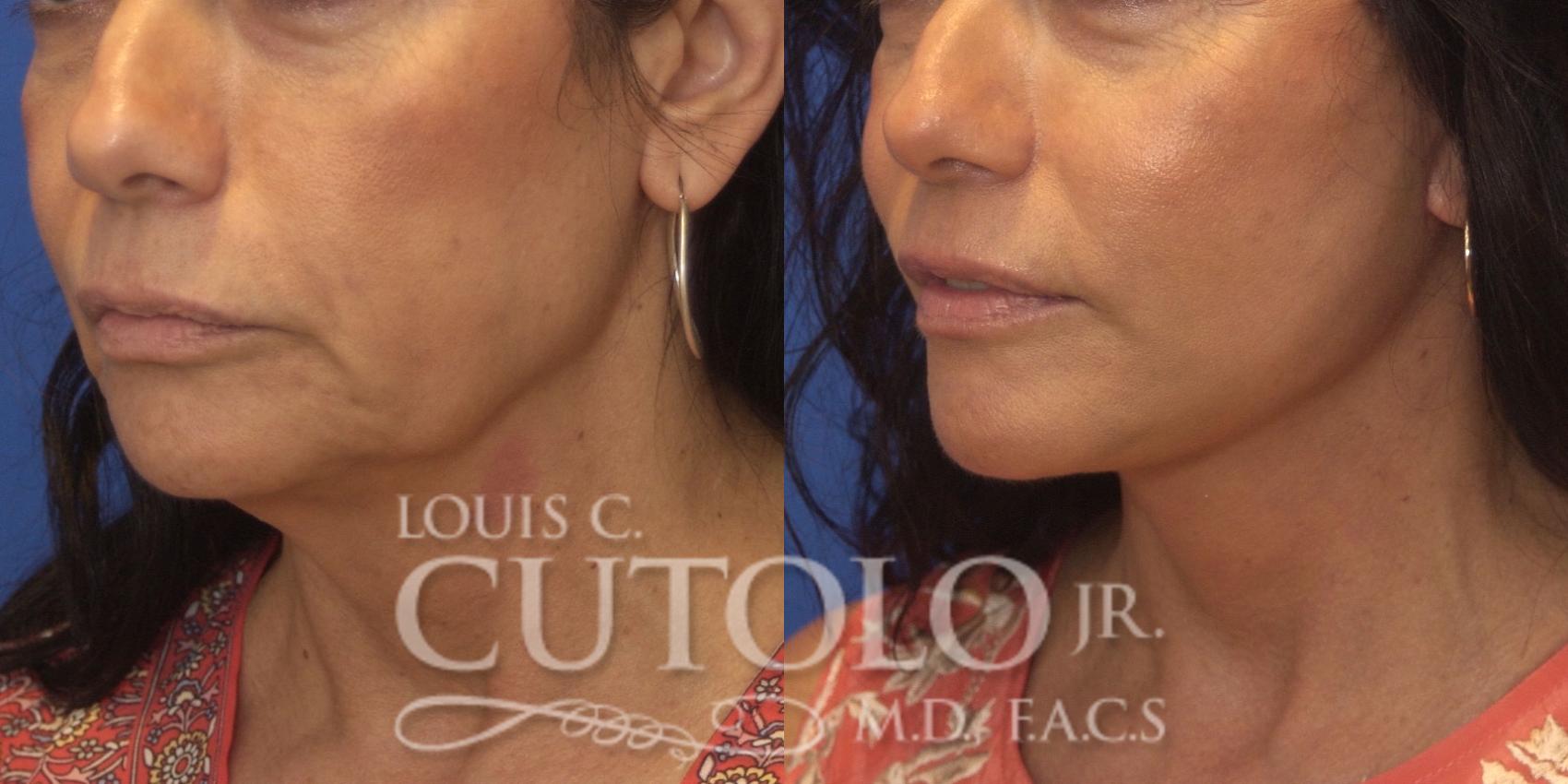 Before & After Rejuvelift™ - Mini Lift Case 247 Left Oblique View in Brooklyn, Staten Island, Queens, NY