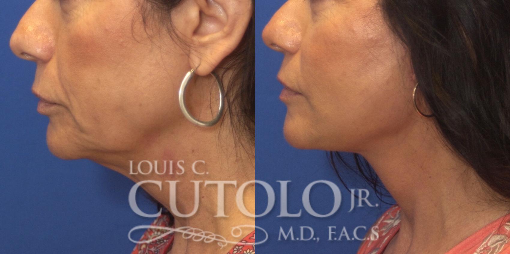 Before & After Rejuvelift™ - Mini Lift Case 247 Left Side View in Brooklyn, Staten Island, Queens, NY