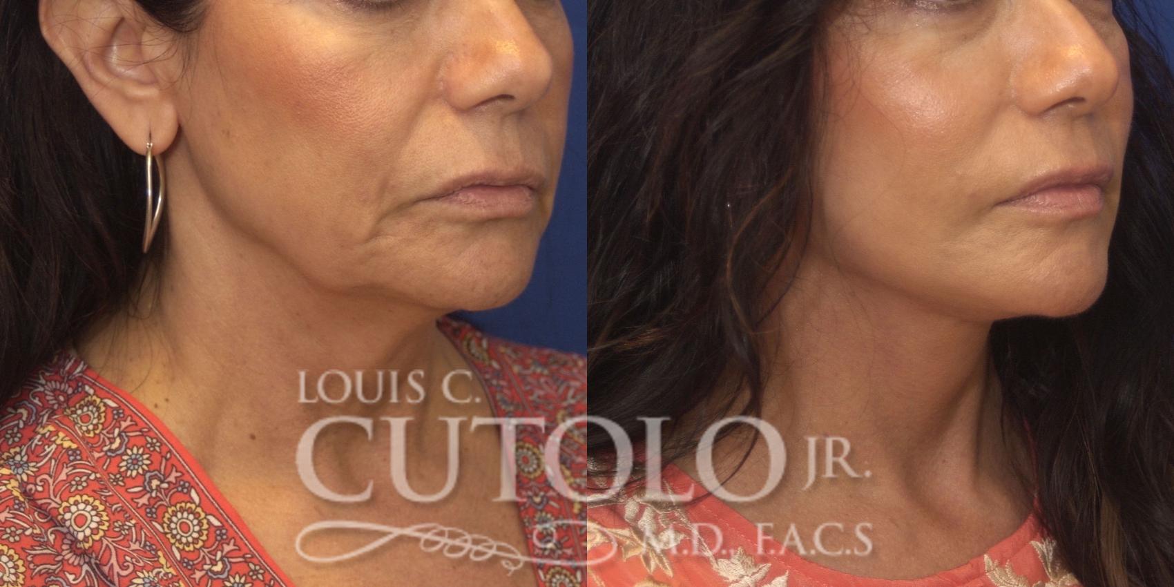 Before & After Rejuvelift™ - Mini Lift Case 247 Right Oblique View in Brooklyn, Staten Island, Queens, NY