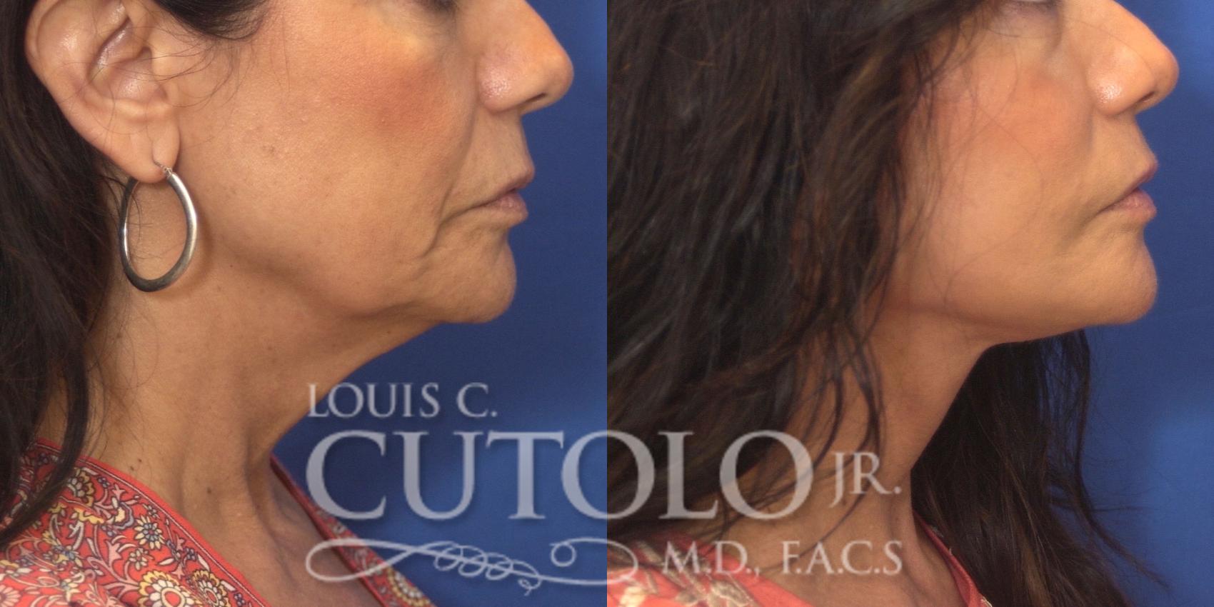 Before & After Rejuvelift™ - Mini Lift Case 247 Right Side View in Brooklyn, Staten Island, Queens, NY