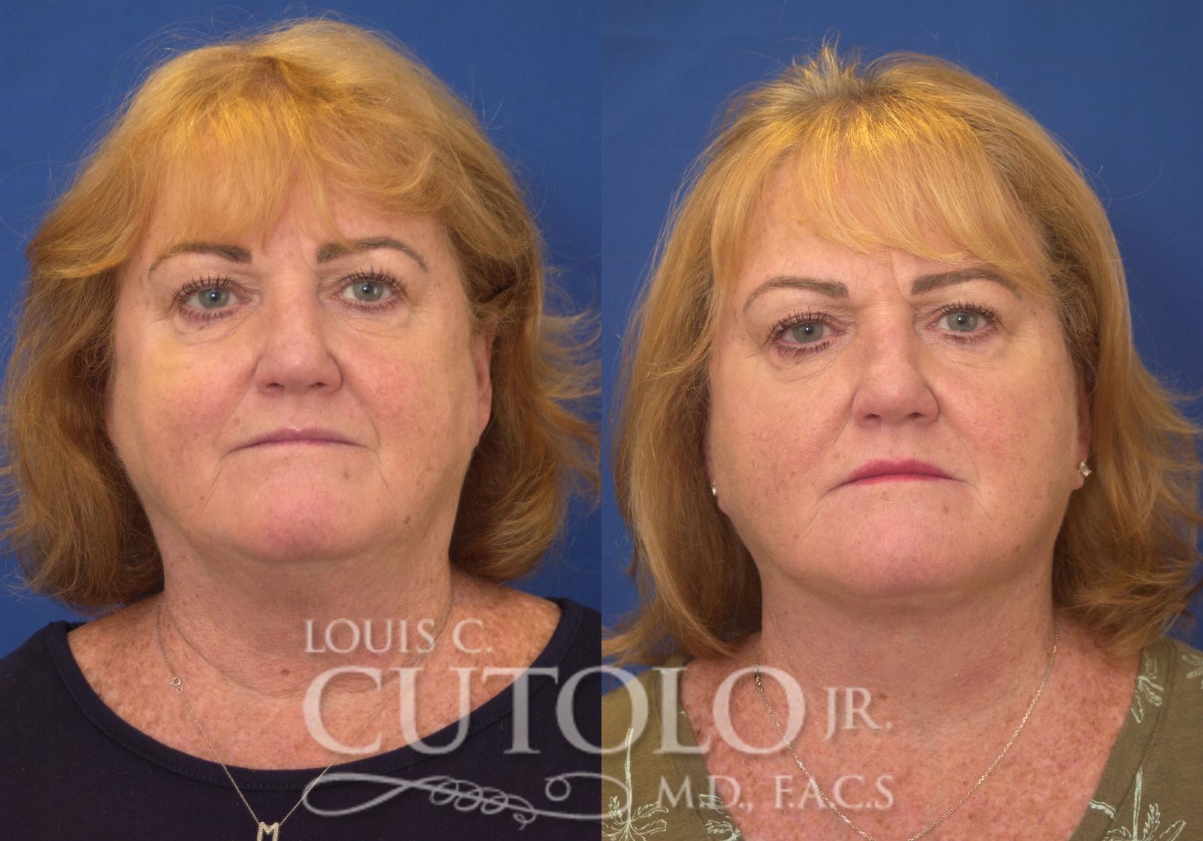 Before & After Rejuvelift™ Case 249 Front View in Brooklyn, Staten Island, Queens, NY