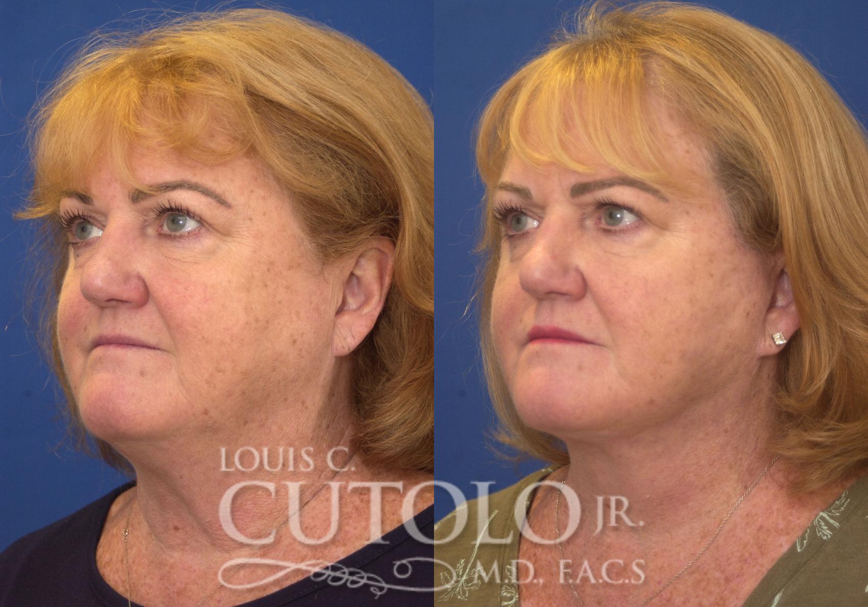 Before & After Rejuvelift™ - Mini Lift Case 249 Left Oblique View in Brooklyn, Staten Island, Queens, NY