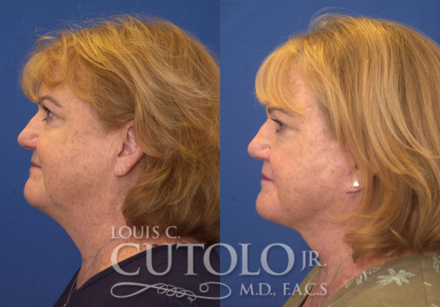 Before & After Rejuvelift™ - Mini Lift Case 249 Left Side View in Brooklyn, Staten Island, Queens, NY