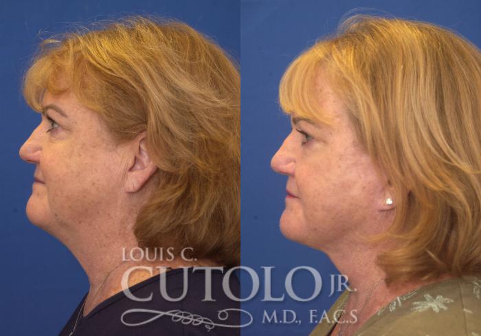 Before & After Rejuvelift™ Case 249 Left Side View in Brooklyn, Staten Island, Queens, NY