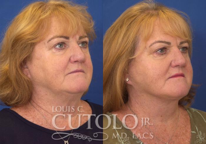 Before & After Rejuvelift™ Case 249 Right Oblique View in Brooklyn, Staten Island, Queens, NY
