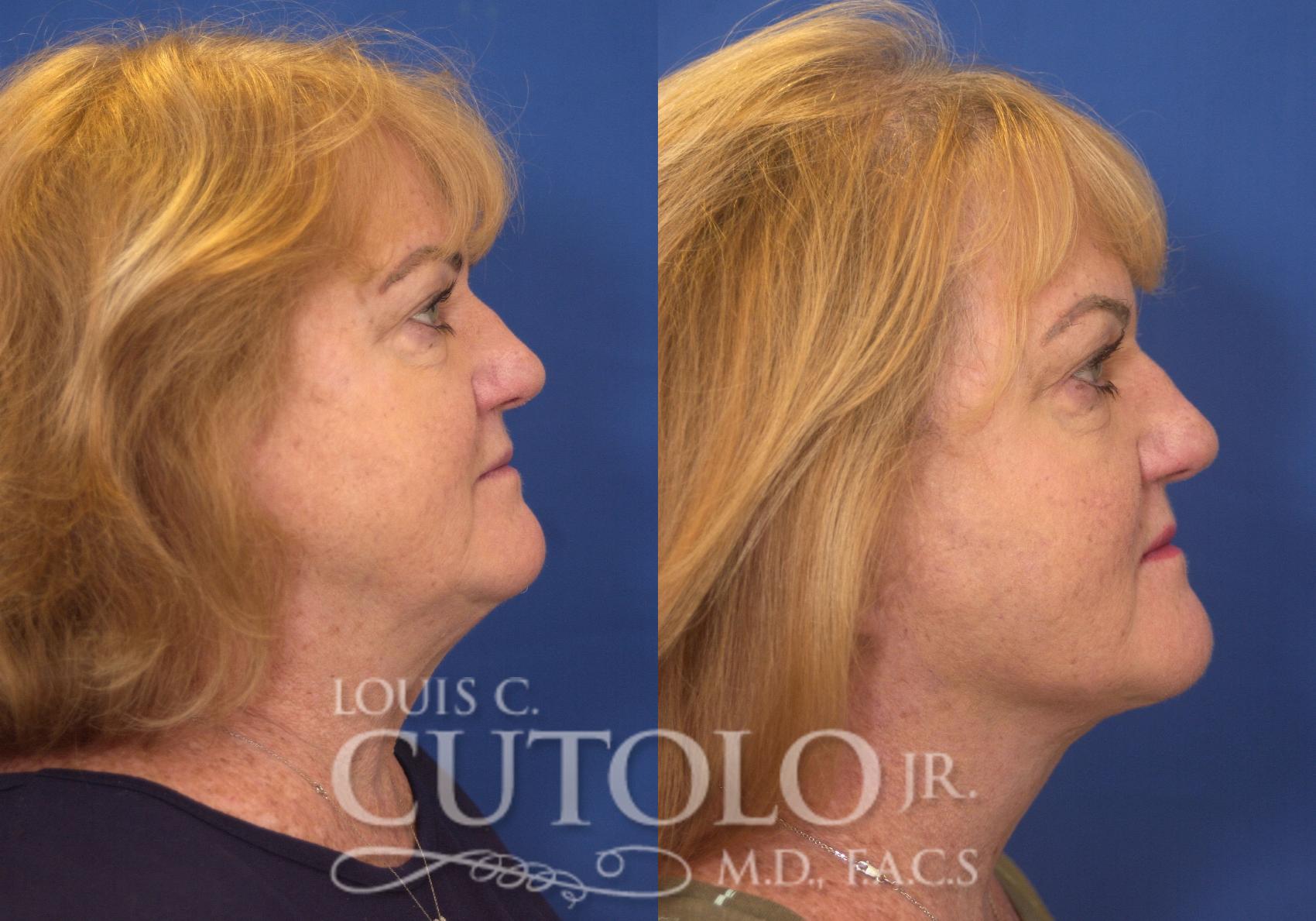Before & After Rejuvelift™ - Mini Lift Case 249 Right Side View in Brooklyn, Staten Island, Queens, NY