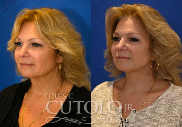 Before & After Rejuvelift™ - Mini Lift Case 258 Left Oblique View in Brooklyn, Staten Island, Queens, NY