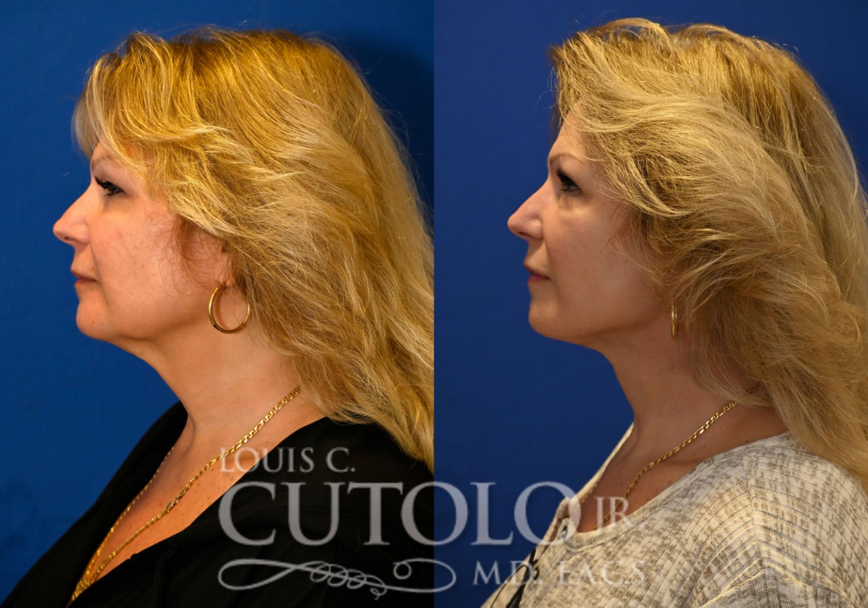 Before & After Rejuvelift™ - Mini Lift Case 258 Left Side View in Brooklyn, Staten Island, Queens, NY