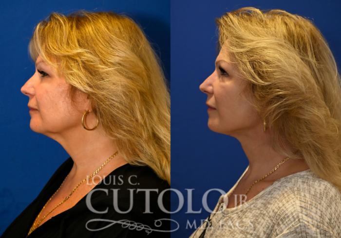Before & After Rejuvelift™ - Mini Lift Case 258 Left Side View in Brooklyn, Staten Island, Queens, NY