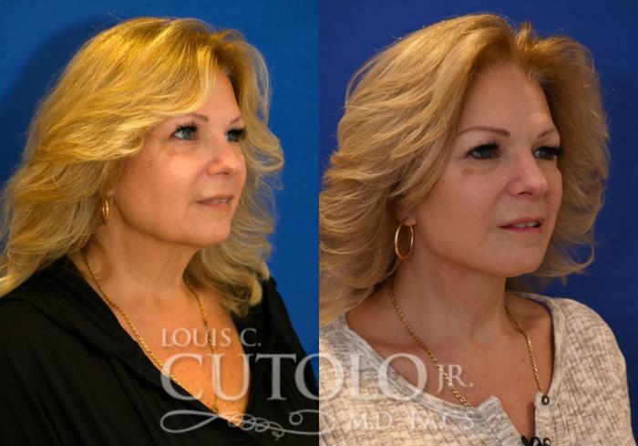 Before & After Rejuvelift™ - Mini Lift Case 258 Right Oblique View in Brooklyn, Staten Island, Queens, NY