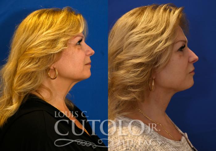 Before & After Rejuvelift™ - Mini Lift Case 258 Right Side View in Brooklyn, Staten Island, Queens, NY