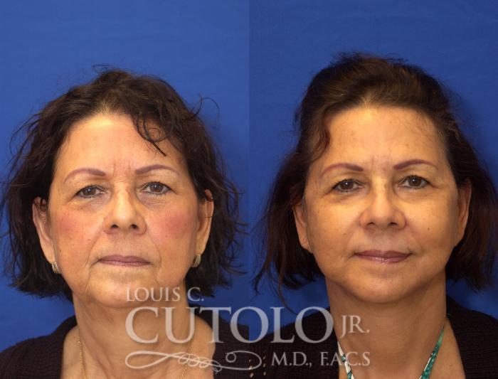 Before & After Rejuvelift™ Case 48 View #1 View in Brooklyn, Staten Island, Queens, NY