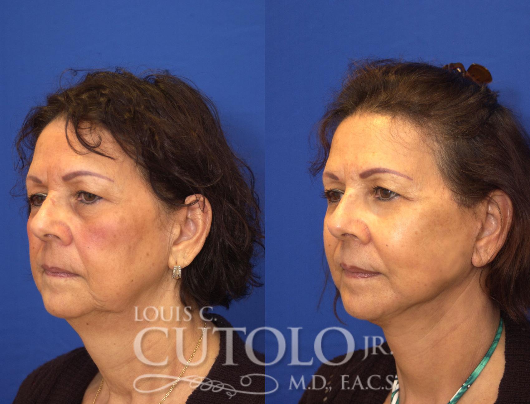 Before & After Rejuvelift™ - Mini Lift Case 48 View #2 View in Brooklyn, Staten Island, Queens, NY