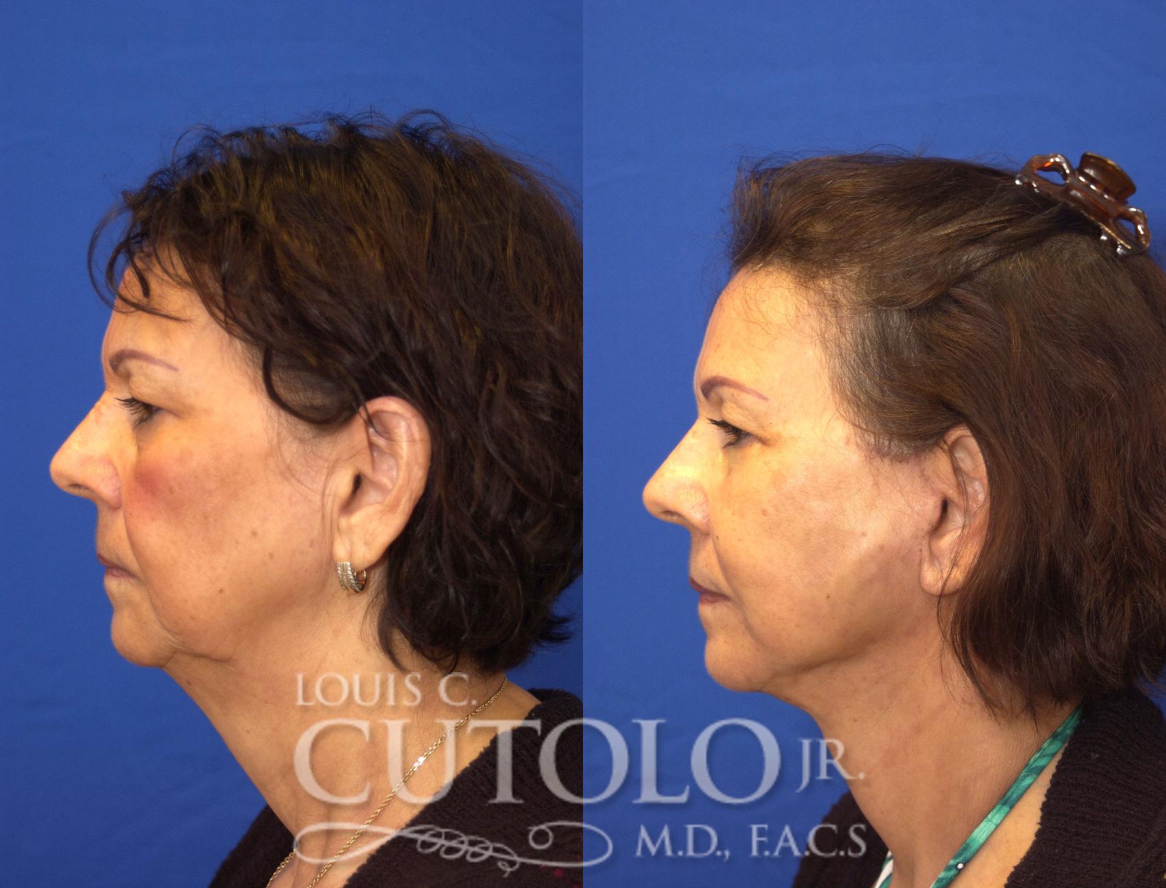 Before & After Rejuvelift™ - Mini Lift Case 48 View #3 View in Brooklyn, Staten Island, Queens, NY
