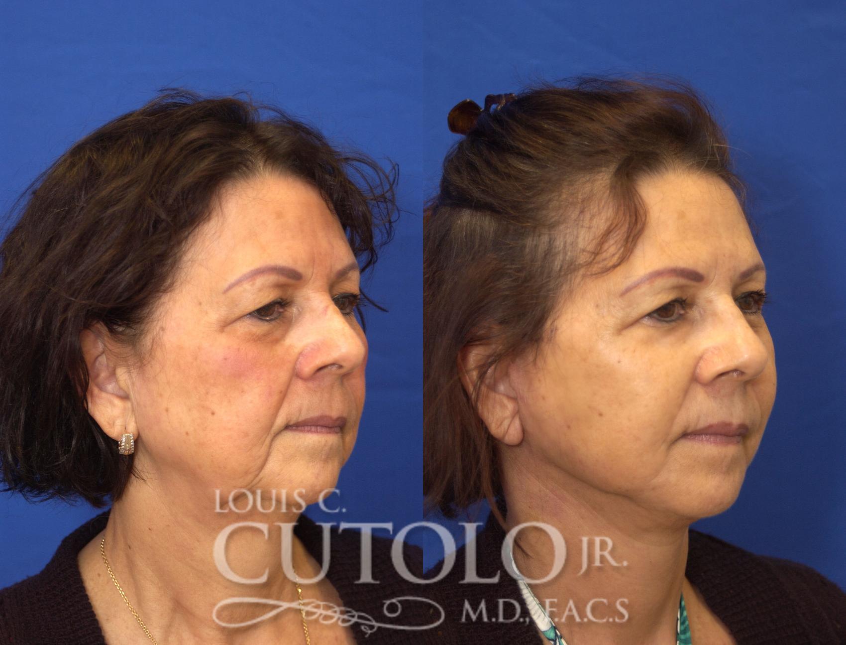 Before & After Rejuvelift™ - Mini Lift Case 48 View #4 View in Brooklyn, Staten Island, Queens, NY