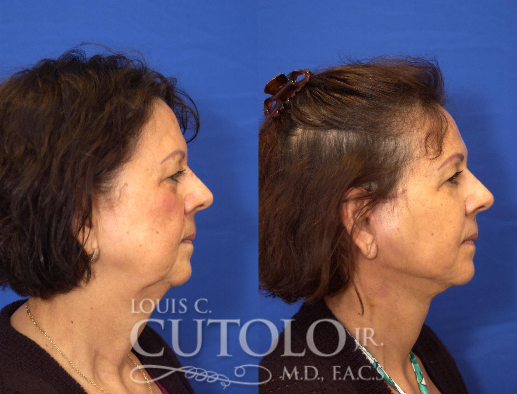 Before & After Rejuvelift™ - Mini Lift Case 48 View #5 View in Brooklyn, Staten Island, Queens, NY