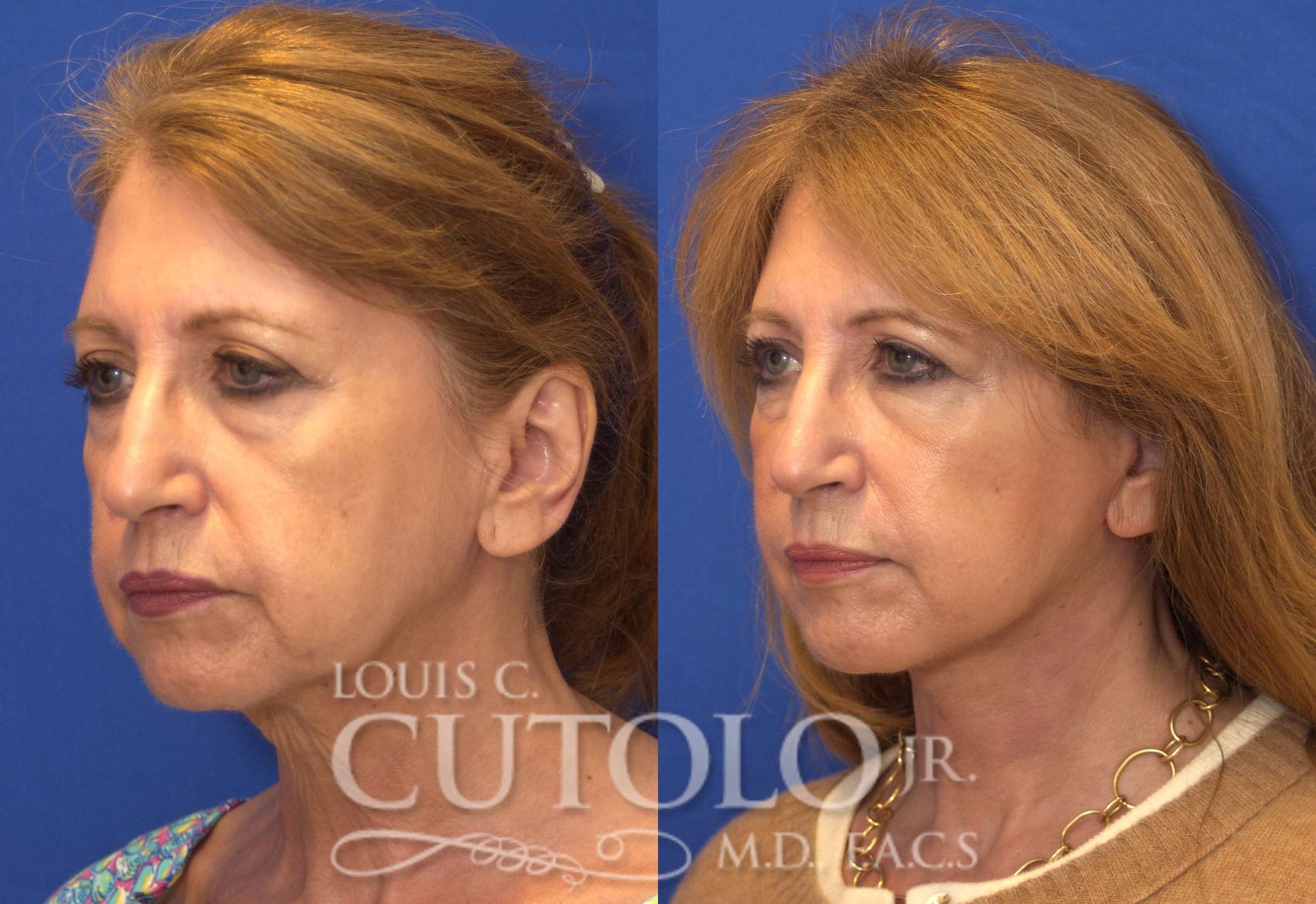 Before & After Rejuvelift™ - Mini Lift Case 56 View #2 View in Brooklyn, Staten Island, Queens, NY