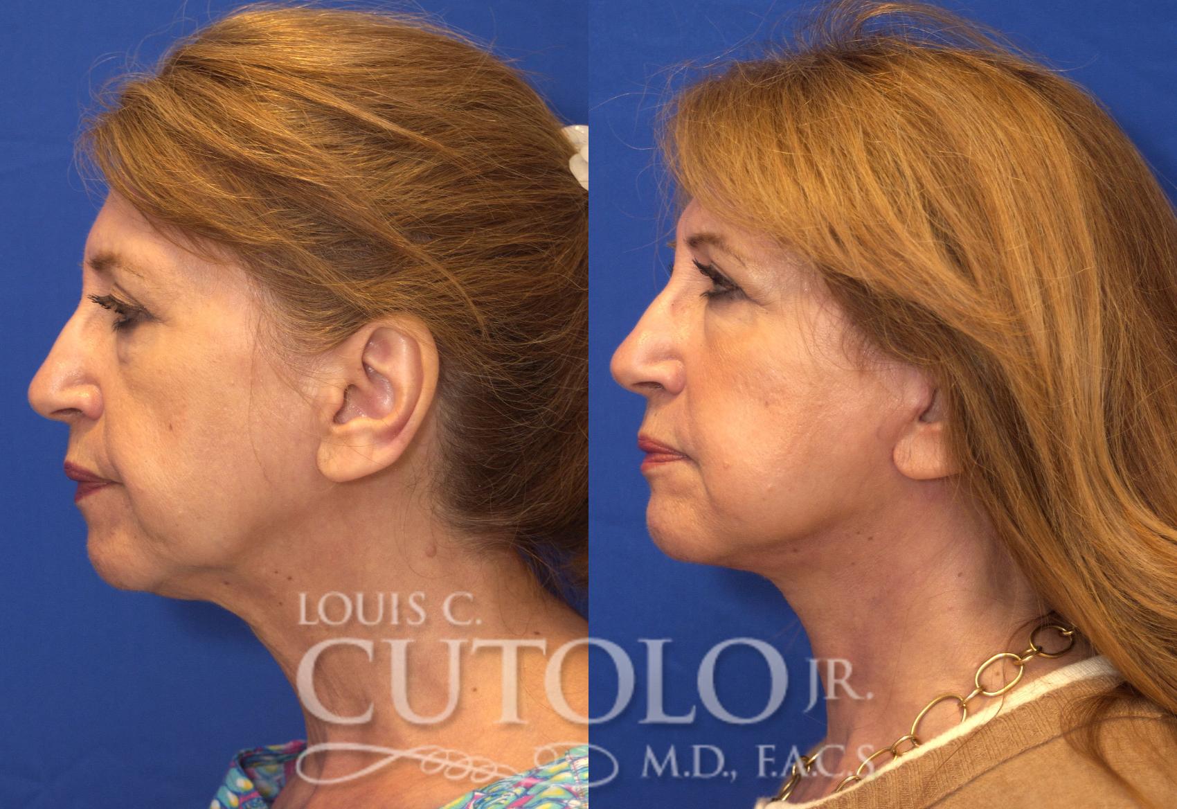Before & After Rejuvelift™ - Mini Lift Case 56 View #3 View in Brooklyn, Staten Island, Queens, NY