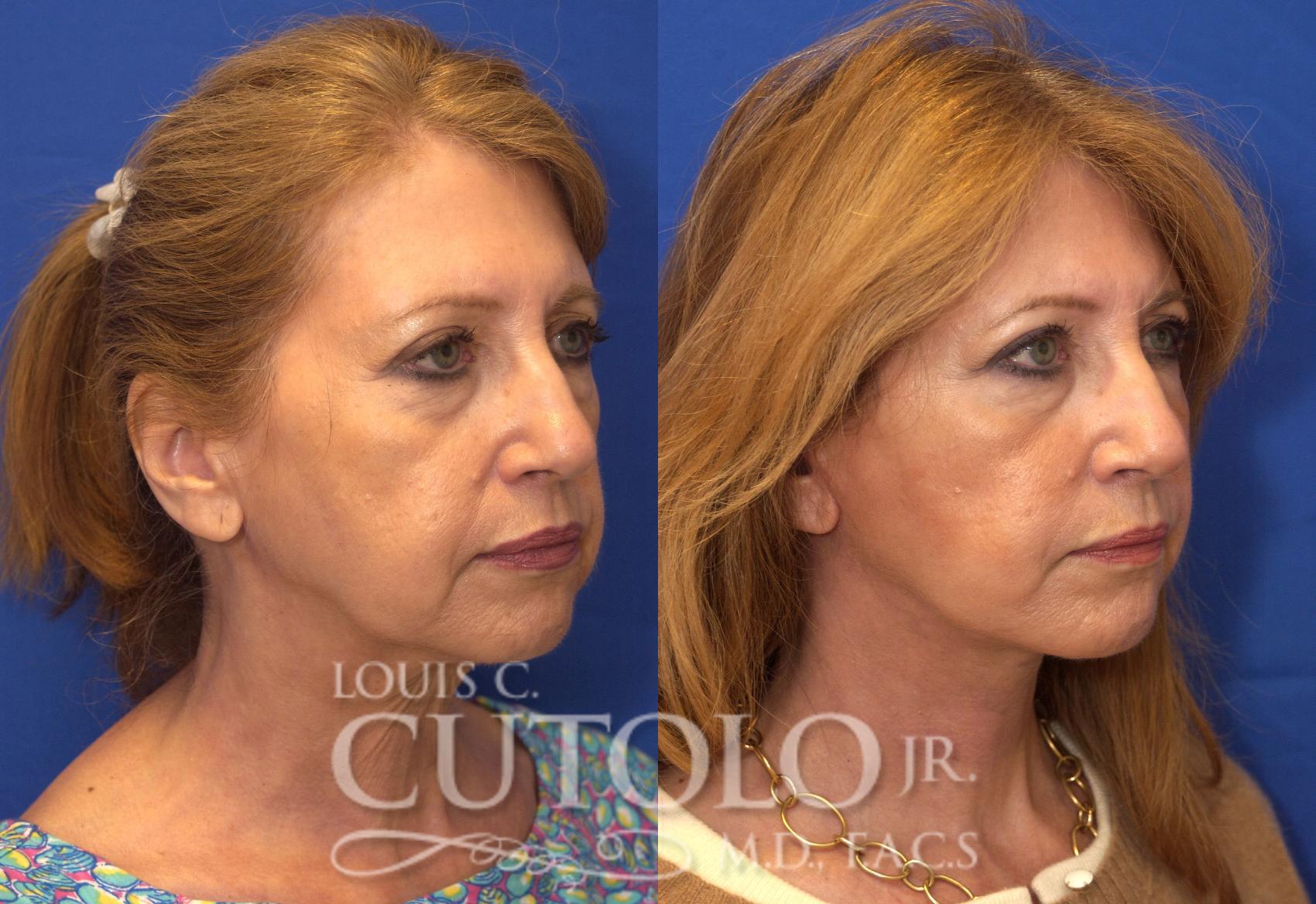 Before & After Rejuvelift™ - Mini Lift Case 56 View #4 View in Brooklyn, Staten Island, Queens, NY