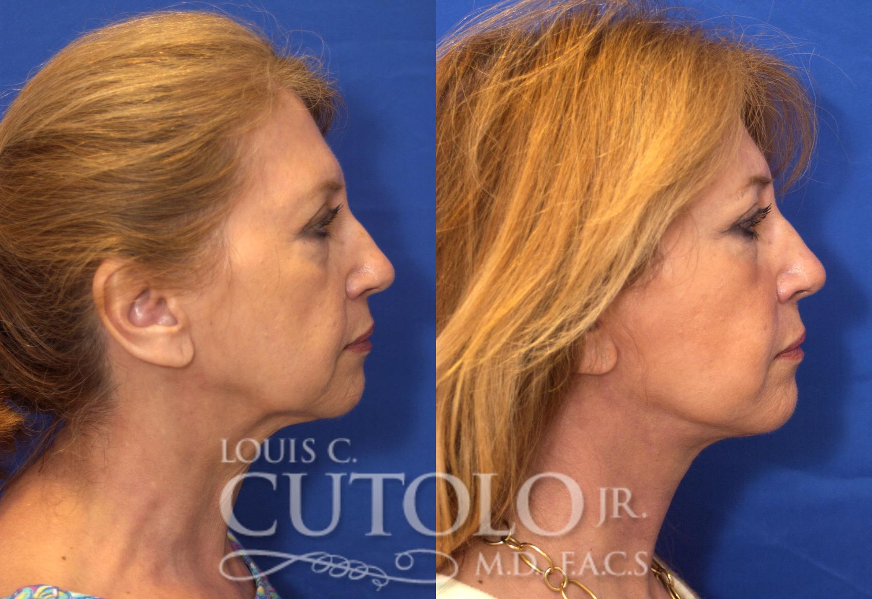 Before & After Rejuvelift™ - Mini Lift Case 56 View #5 View in Brooklyn, Staten Island, Queens, NY