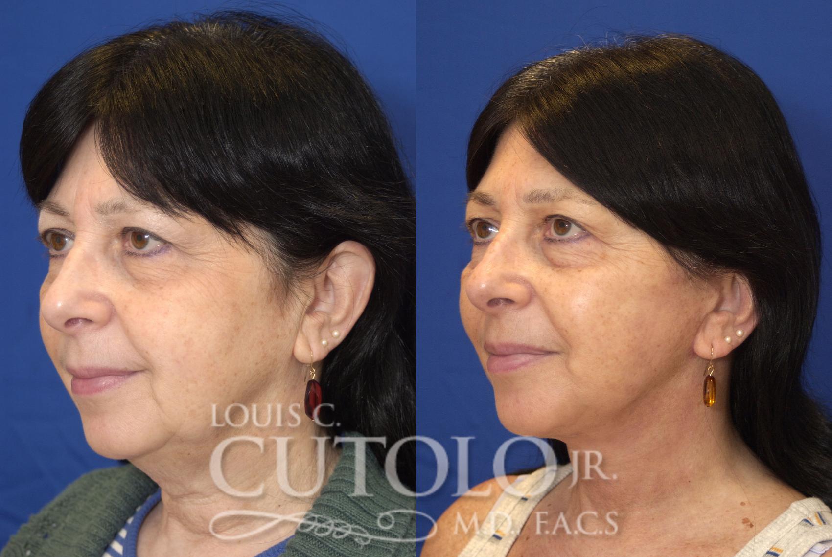 Before & After Rejuvelift™ - Mini Lift Case 81 View #2 View in Brooklyn, Staten Island, Queens, NY