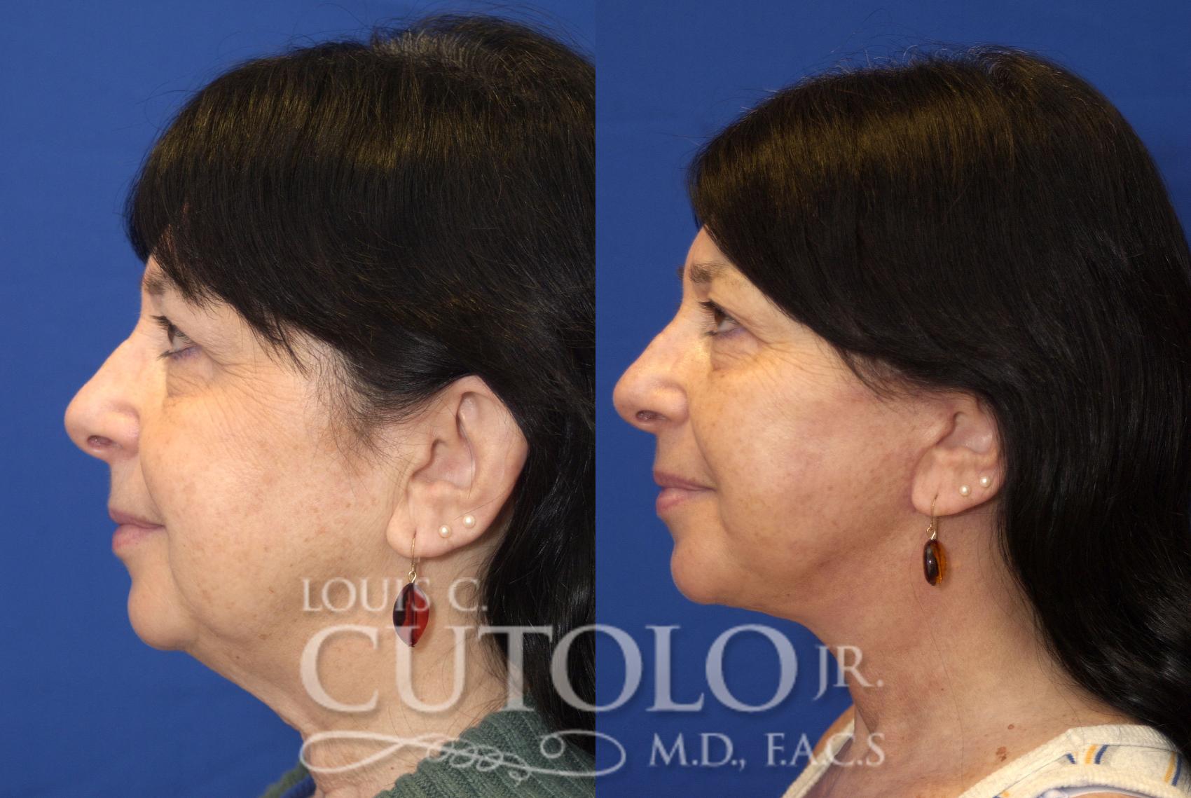 Before & After Rejuvelift™ - Mini Lift Case 81 View #3 View in Brooklyn, Staten Island, Queens, NY